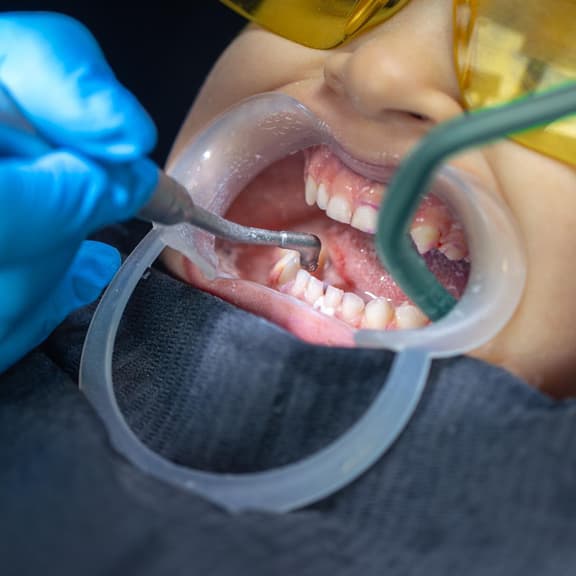 whitening