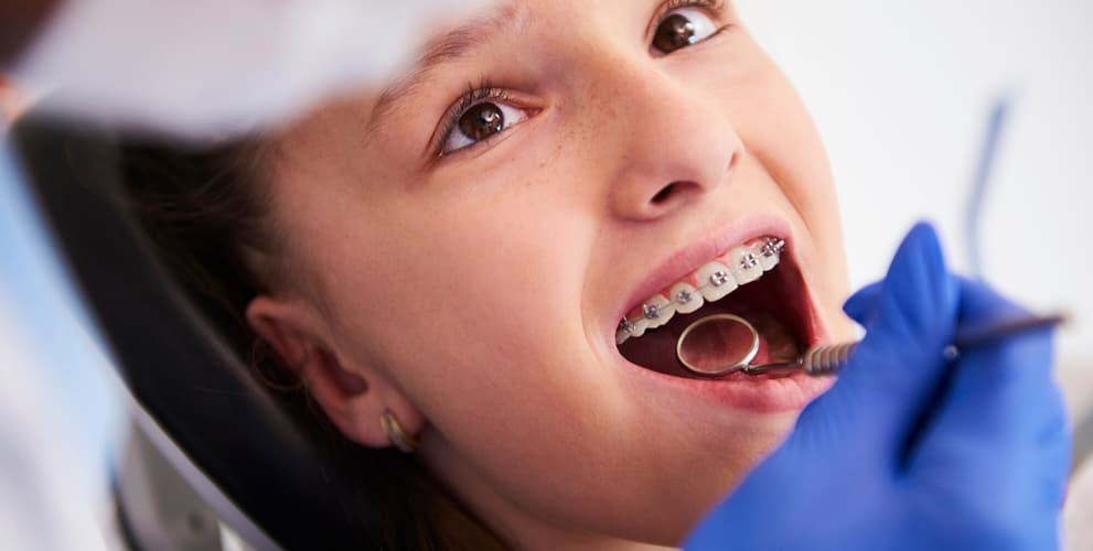 dental bonding