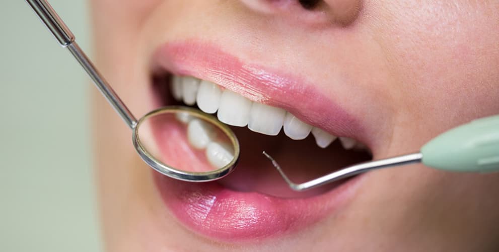 dental bridge