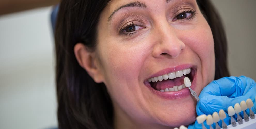 porcelain veneers
